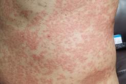 去赤峰化療求助電話號(hào)碼是多少