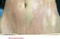 赤峰修復妊娠紋醫(yī)院電話號碼