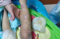 赤峰市燙傷科醫(yī)院電話號碼