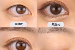 赤峰雙眼皮平價醫(yī)生電話號碼