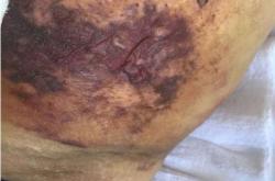 赤峰專業(yè)祛疤店地址電話號碼