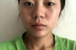 赤峰附屬雙眼皮醫(yī)生電話號碼