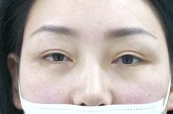 赤峰做雙眼皮醫(yī)院簡(jiǎn)介電話號(hào)碼