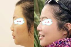 赤峰市鼻梁假體公司電話號碼