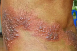 赤峰市帶狀皰疹醫(yī)院電話號碼