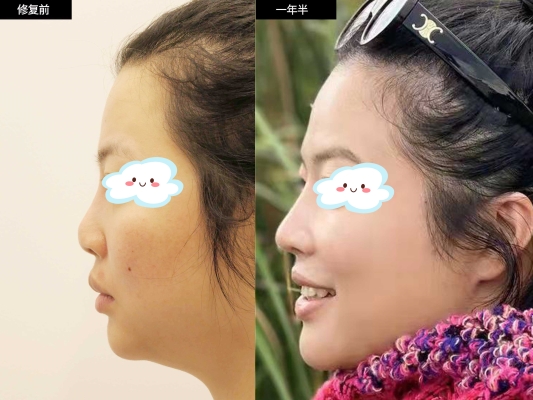 赤峰市鼻梁假體公司電話號(hào)碼-第1張圖片