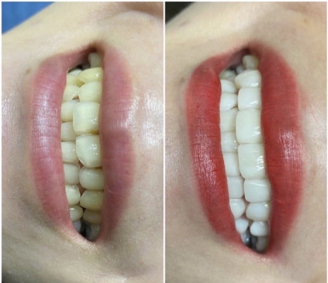 赤峰市牙齒瓷貼面店電話號(hào)碼-第1張圖片