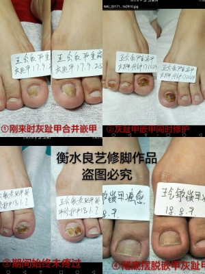 赤峰修腳趾甲店電話號碼-第1張圖片