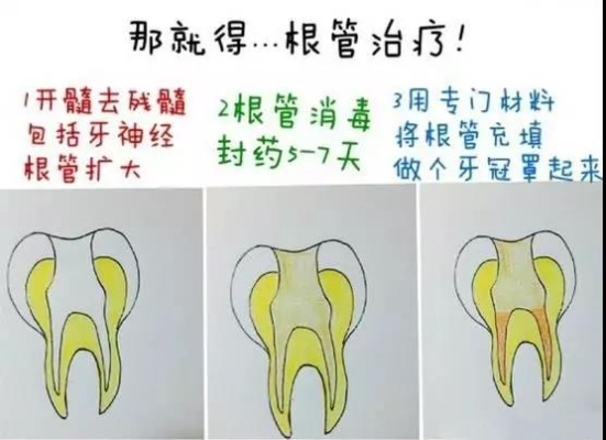赤峰蛀牙補牙團購電話號碼查詢-第1張圖片