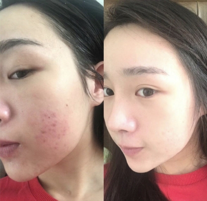 赤峰針清祛痘店地址電話號(hào)碼-第1張圖片