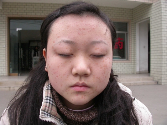 赤峰扁平疣醫(yī)院電話號碼是多少-第1張圖片