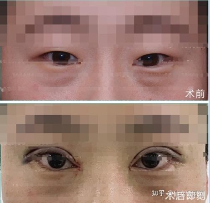 赤峰腫眼泡雙眼皮醫(yī)生電話號碼-第1張圖片