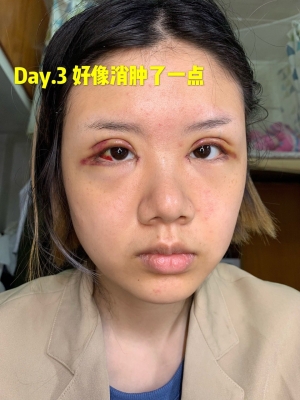 赤峰腫眼泡雙眼皮醫(yī)院電話號碼-第1張圖片