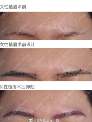 赤峰市眉毛種植醫(yī)院電話號(hào)碼-第1張圖片