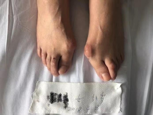 赤峰大腳骨治療醫(yī)院-第1張圖片