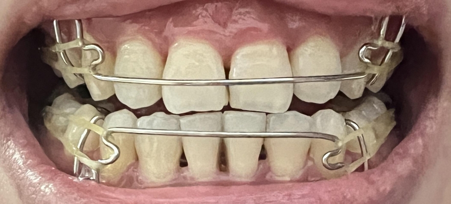 赤峰矯正大舌頭醫(yī)生電話號(hào)碼-第1張圖片