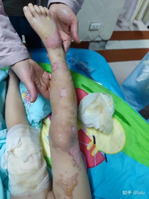 赤峰市燙傷科醫(yī)院電話號碼-第1張圖片