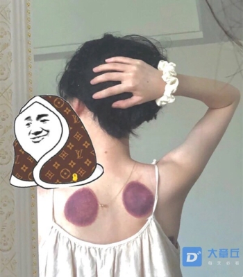 赤峰拔火罐團購地址電話號碼-第1張圖片