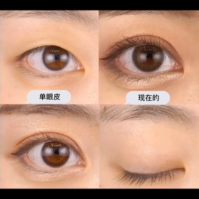 赤峰雙眼皮平價醫(yī)生電話號碼-第1張圖片