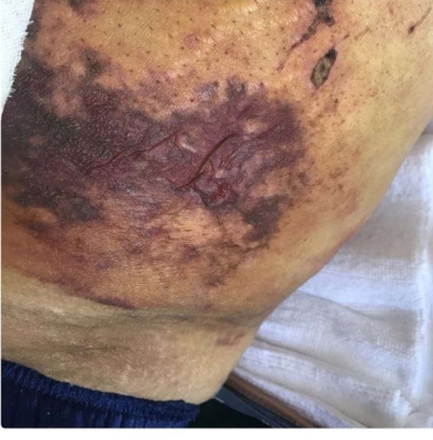 赤峰專業(yè)祛疤店地址電話號碼-第1張圖片